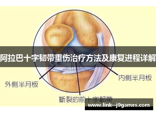 阿拉巴十字韧带重伤治疗方法及康复进程详解 阿拉巴十字韧带重伤治疗方法及康复进程详解